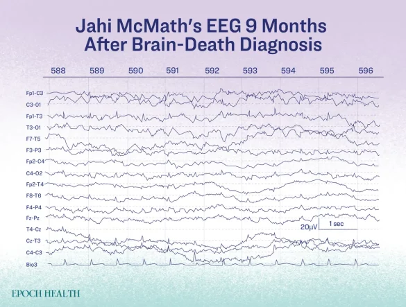 Id5659887 Brain Death Infographic 03 